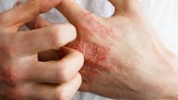 Eczema: Cum să îți calmezi pielea și să previi recidivele